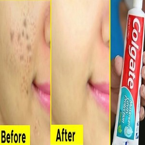 361K views · 6.4K reactions | But, while it's true that several ingredients found in toothpaste are drying to skin and ... You're washing your face before bedtime and spot the beginnings of an ... Lactic acid is specifically used to treat hyperpigmentation, age spots, and other | Health Zone | Facebook