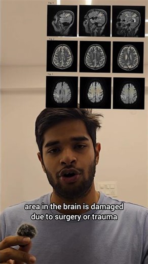 alien hand Syndrome ......#mbbscollege #motivation #case #hospital #explained #