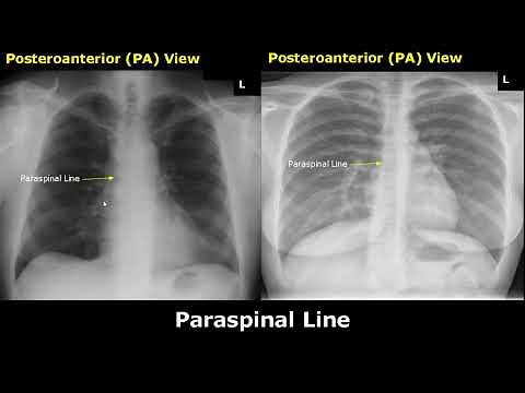 Normal Chest X-Ray Labelled Anatomy PA View Part 2: CXR Interpretation | Mediastinum Radiography