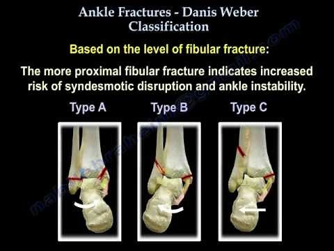 Ankle Fractures Danis Weber Classification - Everything You Need To Know - Dr. Nabil Ebraheim