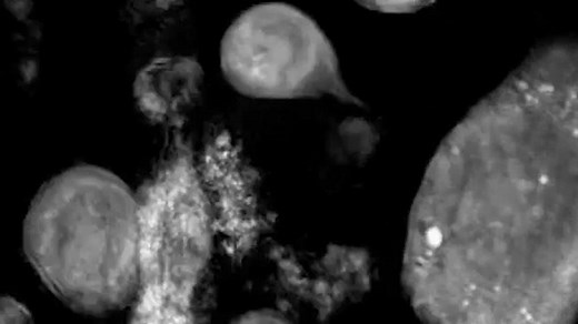 Watch genetically modified T-cells kill cancer cells