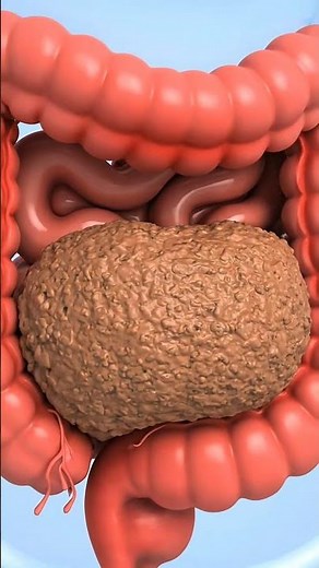 Constipation Explained 🧠 | How Hard Stool Blocks the Colon (3D Animation)