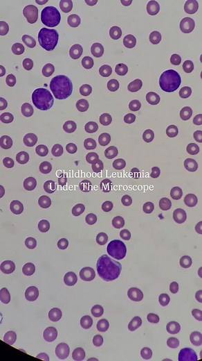 This is what a child’s blood cancer may look like under the microscope. ALL: Acute Lymphoblastic Leukemia. It’s more than just cells under the microscope; it’s a diagnosis that changes lives. ALL is a cancer of the bone marrow and lymphoid line, where immature white blood cells (lymphoblasts) multiply uncontrollably, crowding out healthy cells that your body needs to function. Under the microscope, you’ll see: Large lymphoblasts with high nuclear-to-cytoplasmic ratios Scant cytoplasm, fine chrom
