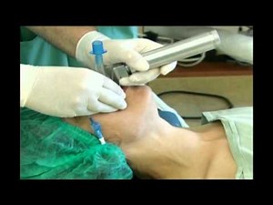 tracheal intubation