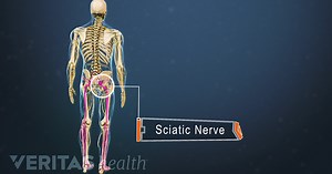 How to Apply Heat Therapy for Your Sciatica Symptoms