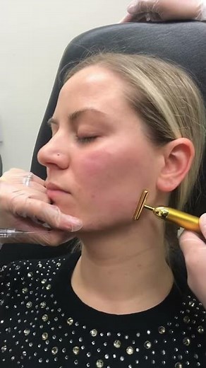 Jawline Filler Injection Technique by Dr. Tina Ho