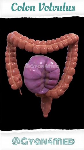 Colon Volvulus