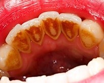 How to Remove Tartar from Teeth Fast [Using 19 Tips]