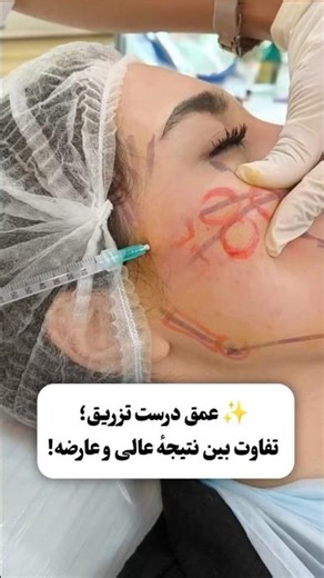 عمق صحیح تزریق؛ تفاوت بین نتیجه عالی و عارضه! 🔥 آموزش زیبایی| Correct Injection Depth Explained!