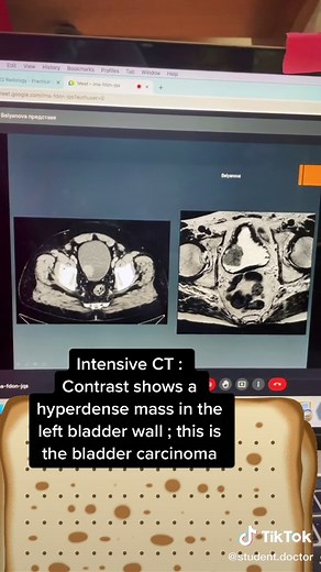 Understanding Bladder Cancer Through CT Imaging