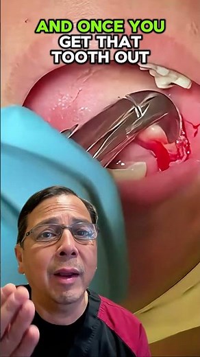 Simple & Painless Tooth Extraction Explained! | View Mobile Dental #shorts