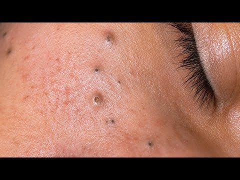 Deep Cleansing Techniques & Pimples | Blackhead Removal Facial Care Routine