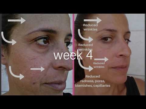 Project E Beauty LED Mask 30-Day Trial | LED Mask Before & After