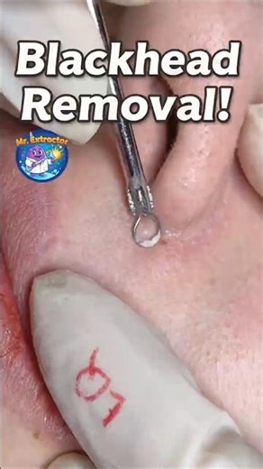 Deep Sebum Worms Removed — So Addictive to Watch!