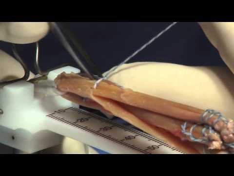 Hamstring Autograft Technique for ACL Reconstruction Surgery