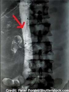 Deep Vein Thrombosis (DVT) NCLEX Review
