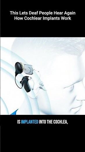 How Cochlear Implants Work - Curing Deafness with Technology