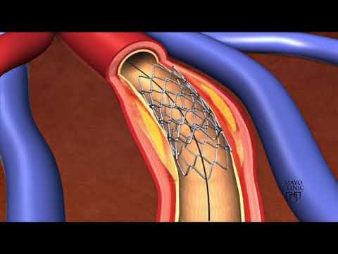 Mini Lesson 5: What is a Shape Memory Alloy?