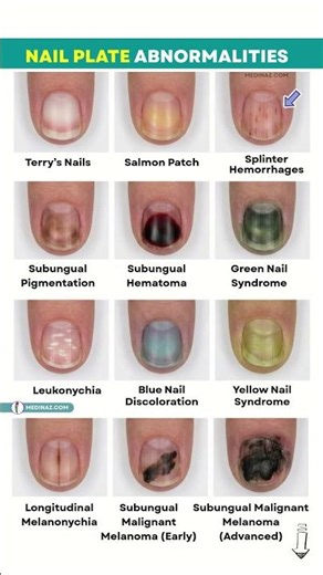 Nail Plate Abnormalities You Should Know | Nail Diseases