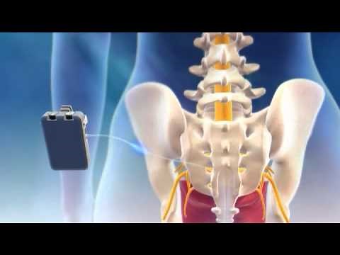 Overview of Sacral Nerve Stimulation for Urinary Control