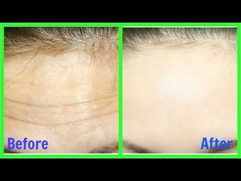 How to Remove Wrinkles from Face & Forehead naturally || Home Remedy