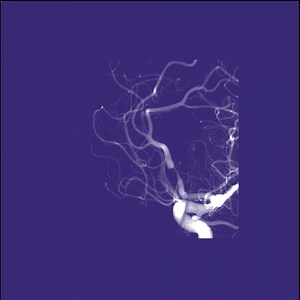 MRA and Flow MRI: Phase contrast angiography | e-MRI