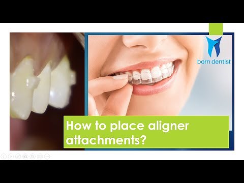 How to place attachments - Attachments for aligners