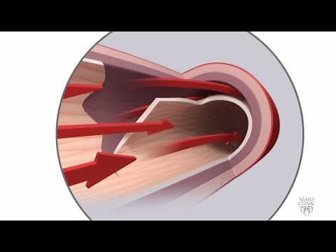 Spontaneous coronary artery dissection (SCAD) Animation