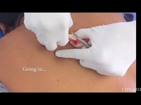 Sebaceous Cysts Removal - The Largest One to date...!!