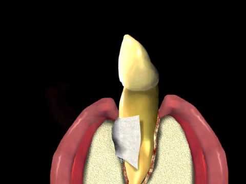 Guided Tissue Regeneration