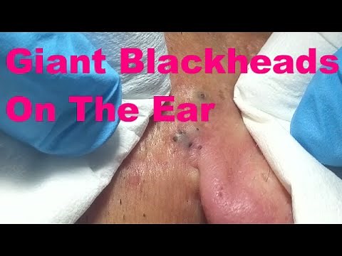 Giant Blackheads - Part I -