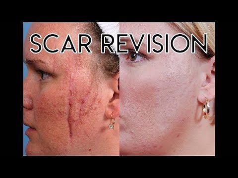 Scar Revision