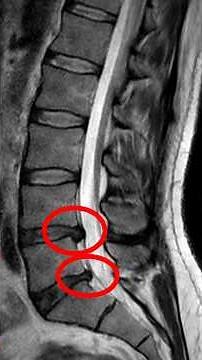 🦴 Slip Disc Stages Explained — Which One Is Yours? 🤔