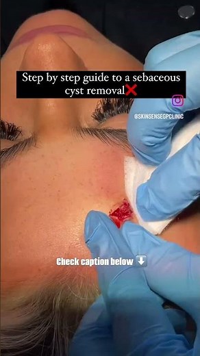 Step by step guide to a sebaceous cyst removal