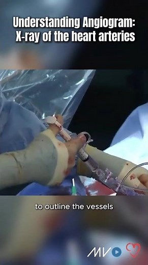 Understanding Angiogram: X-ray of the heart arteries #cardiology