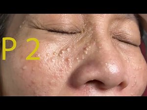 Make your Acne Treatment Huong Da Nang#502 | acne 2022 PArt 2