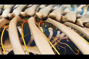 2.3K views · 23 reactions | Spinal Compression Fracture...