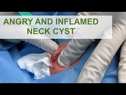 Angry Inflamed Neck Cyst | Dr. Derm