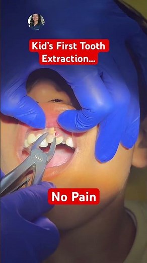 Kid’s First Tooth Extraction | Front Baby Tooth Removal