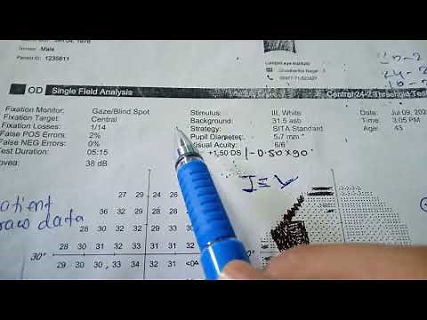 How to interpret Humphrey Visual field printout report