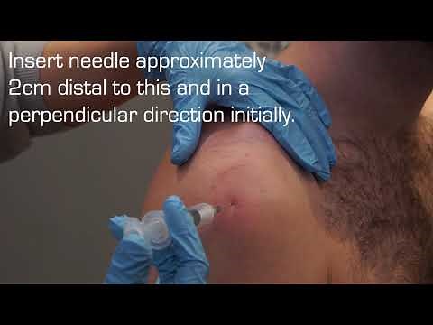 Injection Technique into the Subacromial Space for Rotator Cuff Related Shoulder Pain