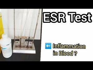 "ESR Test Full Explained | Westergren & Wintrobe Methods | Complete Lab 🔬