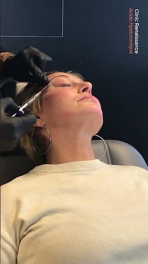 3 infos sur les injections d'acide hyaluronique - Clinic Renaissance