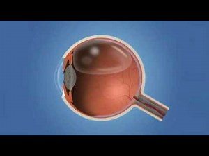 Vitrectomy