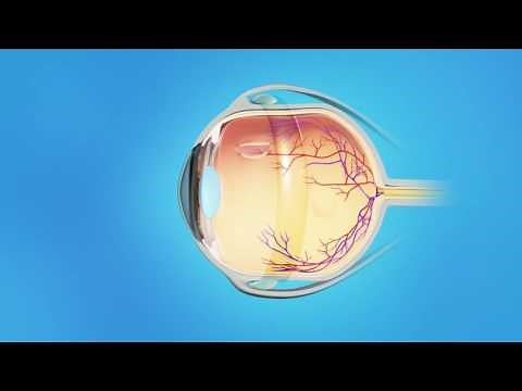 Detached Retina: Scleral Buckle