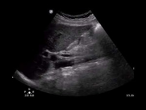 Gallbladder Ultrasound