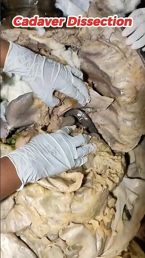 first-year anatomy cadaver dissection