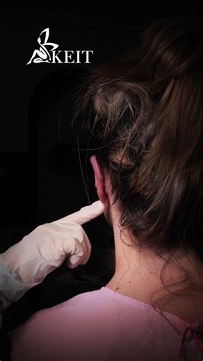 Otoplasty Transformation: Stunning Before & After Results in the Operating Room