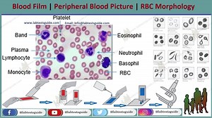 Peripheral Blood Smear Test Purpose, Procedure, Result and many more