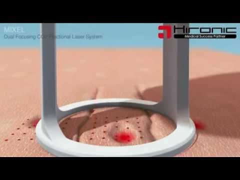 HOW'S CO2 LASER WORKS?